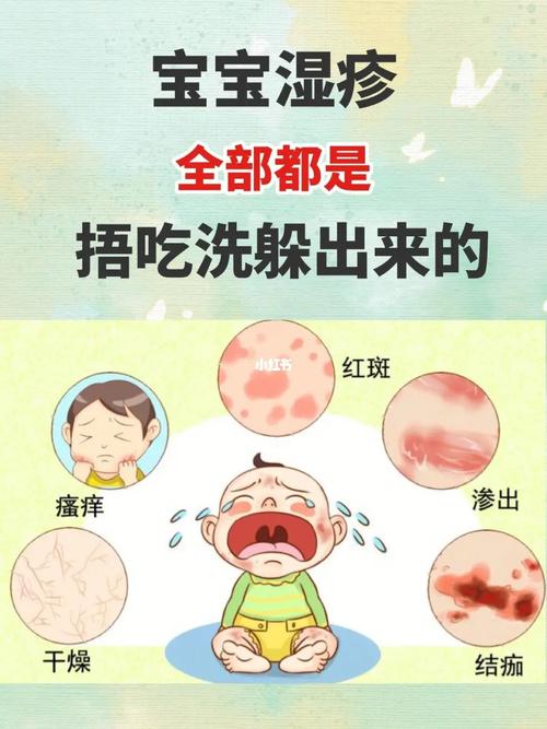 试管婴儿宝宝湿疹是什么引起的